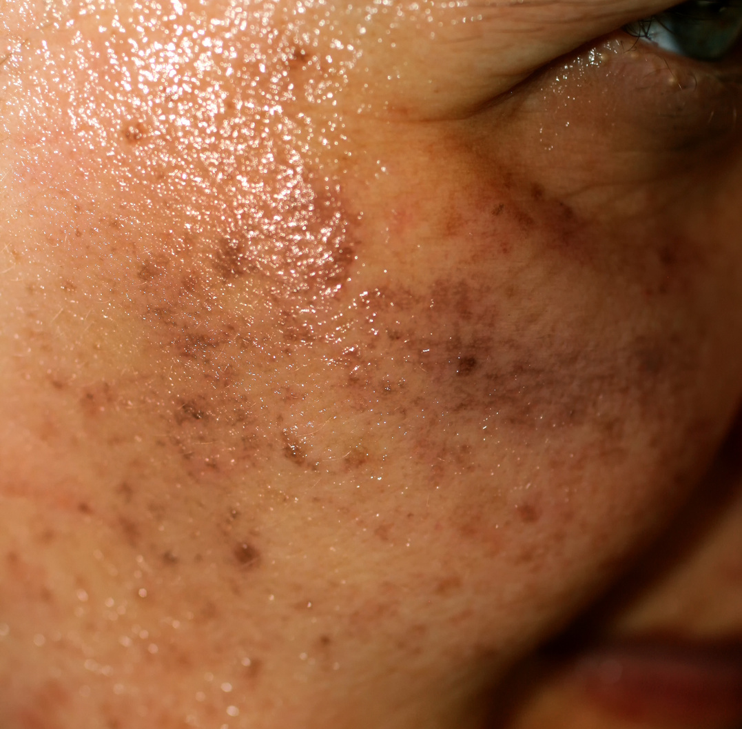 Pigmented spots on the face. Pigmentation on cheeks