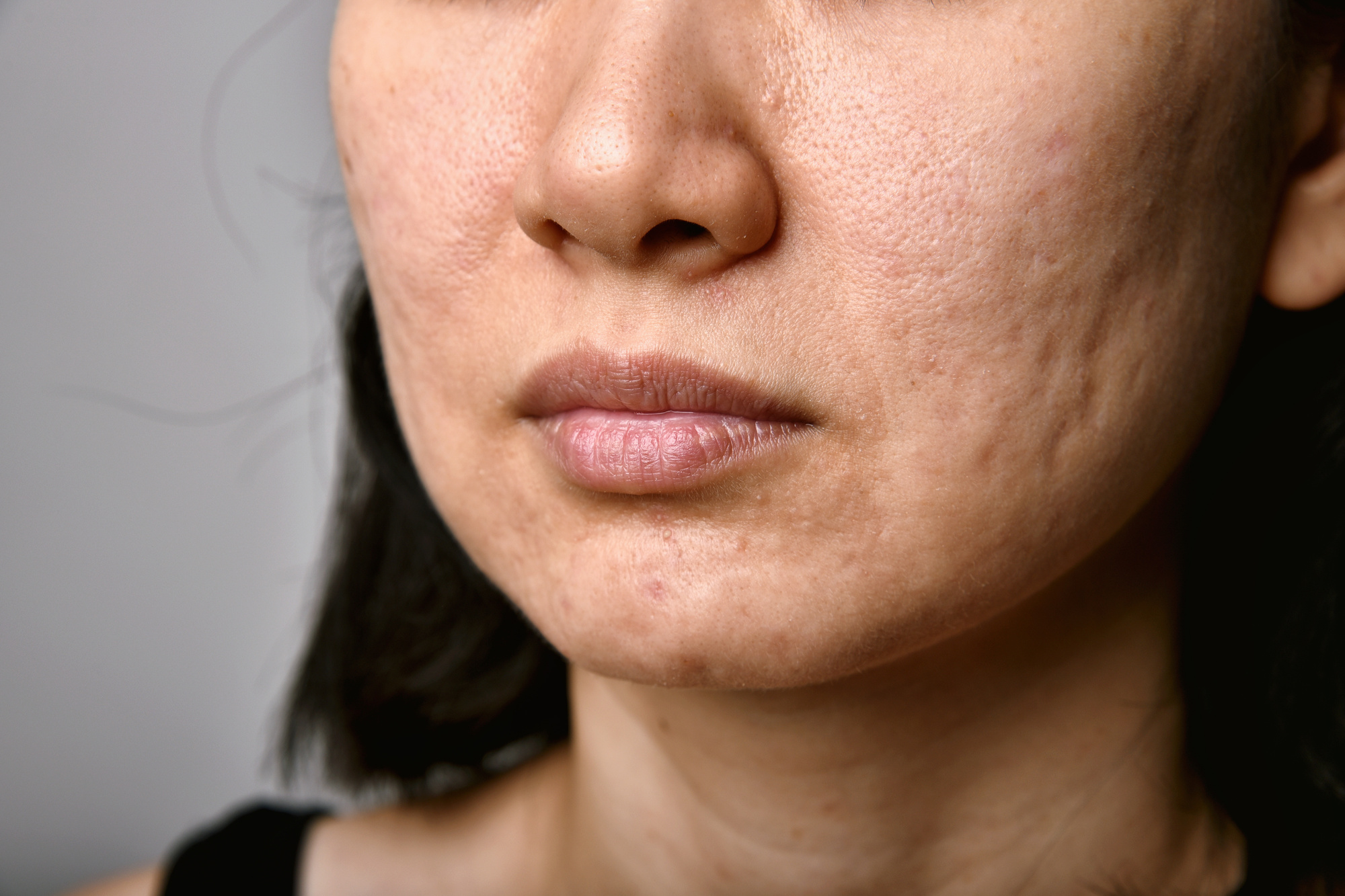 Woman with Acne Problem